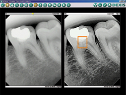 Digital X-Rays Intraoral Camera